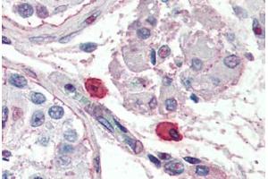 Human Mast Cells (formalin-fixed, paraffin-embedded) stained with Fc Epsilon Receptor 1 (FceR1) antibody ABIN396944 at 10 ug/ml followed by biotinylated anti-mouse IgG secondary antibody ABIN481714, alkaline phosphatase-streptavidin and chromogen. (Fc epsilon Receptor 1 抗体)