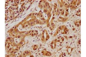 IHC image of ABIN7171764 diluted at 1:100 and staining in paraffin-embedded human liver cancer performed on a Leica BondTM system. (Tensin 4 抗体  (AA 20-231))