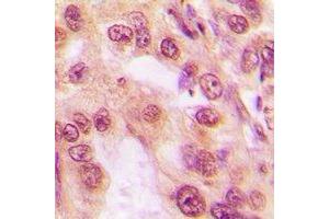 Immunohistochemical analysis of PSMC5 staining in human lung cancer formalin fixed paraffin embedded tissue section. (PSMC5 抗体)