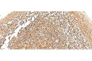 Immunohistochemistry of paraffin-embedded Human tonsil tissue using GRHPR Polyclonal Antibody at dilution of 1:35(x200) (GRHPR 抗体)