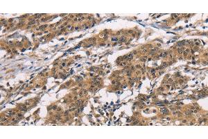 Immunohistochemistry of paraffin-embedded Human gasrtic cancer tissue using ADGRB1 Polyclonal Antibody at dilution 1:40 (ADGRB1 抗体)