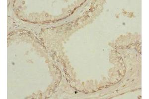 Immunohistochemistry of paraffin-embedded human prostate cancer using ABIN7154259 at dilution of 1:100 (NMT2 抗体  (AA 1-120))