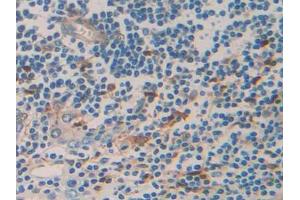 DAB staining on IHC-P; Samples: Human Prostate cancer Tissue (TNFRSF12A 抗体  (AA 24-126))