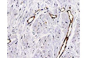 Immunohistochemistry analysis of paraffin-embedded Human hysteromyoma using VWF Polyclonal Antibody at dilution of 1:300. (VWF 抗体)