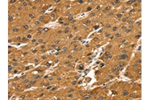 The image on the left is immunohistochemistry of paraffin-embedded Human liver cancer tissue using ABIN7192644(SRGAP1 Antibody) at dilution 1/25, on the right is treated with synthetic peptide. (SRGAP1 抗体)