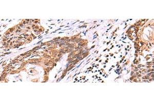 Immunohistochemistry of paraffin-embedded Human esophagus cancer tissue using KATNAL1 Polyclonal Antibody at dilution of 1:95(x200) (KATNAL1 抗体)