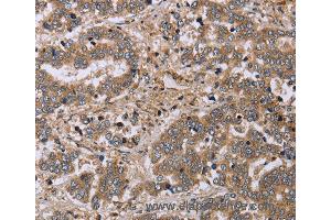 Immunohistochemistry of Human liver cancer using FHL1 Polyclonal Antibody at dilution of 1:20