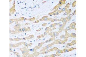 Immunohistochemistry of paraffin-embedded Human liver cancer using FDXR Polyclonal Antibody at dilution of 1:100 (40x lens). (Ferredoxin Reductase 抗体)