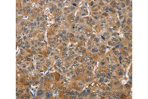 Immunohistochemistry of Human gastric cancer using TRIP4 Polyclonal Antibody at dilution of 1:40 (TRIP4 抗体)