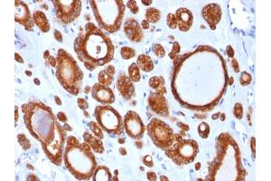 Formalin-fixed, paraffin-embedded human Thyroid Carcinoma stained with Thyroid Peroxidase Mouse Monoclonal Antibody (TPO/1921). (TPO (AA 685-804) 抗体)