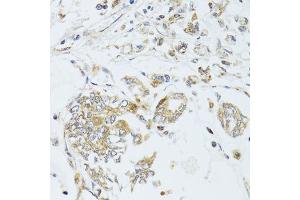 Immunohistochemistry of paraffin-embedded human gastric cancer using MAD2L2 antibody. (MAD2L2 抗体  (AA 1-211))