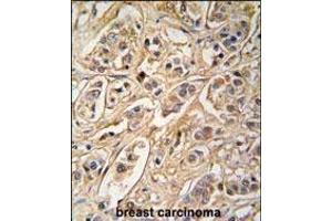 Formalin-fixed and paraffin-embedded human breast carcinoma tissue reacted with 14-3-3 protein zeta/delta antibody (C-term) (ABIN392782 and ABIN2842219) , which was peroxidase-conjugated to the secondary antibody, followed by DAB staining. (14-3-3 zeta 抗体  (AA 216-245))