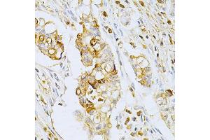 Immunohistochemistry of paraffin-embedded human gastric cancer using OLR1 Antibody (ABIN5970808) at dilution of 1/200 (40x lens). (OLR1 抗体)