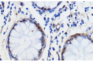 Immunohistochemistry of paraffin-embedded Human colon carcinoma using GCAT Polyclonal Antibody at dilution of 1:100 (40x lens). (GCAT 抗体)