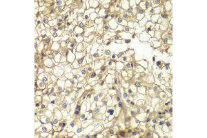 Immunohistochemistry of paraffin-embedded human kidney cancer using CD1D antibody at dilution of 1:200 (400x lens). (CD1d 抗体)