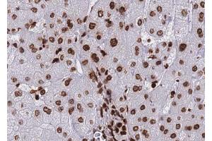 ABIN6267690 at 1/100 staining human Liver carcinoma tissue sections by IHC-P. (HDAC8 抗体  (pSer39))