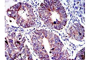 Immunohistochemical analysis of paraffin-embedded human rectum cancer tissues using AIF mouse mAb with DAB staining. (AIF 抗体)