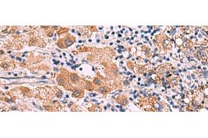 Immunohistochemistry of paraffin-embedded Human liver cancer tissue using IPPK Polyclonal Antibody at dilution of 1:30(x200) (IPPK 抗体)