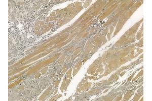 ABIN6257405 and ABIN6273977 at 1/100 staining human tongue carcinoma by IHC-P. (OR2H1 抗体  (C-Term))