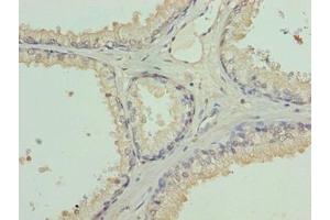 Immunohistochemistry of paraffin-embedded human prostate cancer using ABIN7158010 at dilution of 1:100 (L3MBTL4 抗体  (AA 1-270))