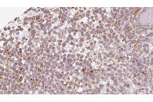 ABIN6273198 at 1/100 staining Human lymph cancer tissue by IHC-P. (ATP8A1 抗体  (Internal Region))