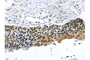 The image on the left is immunohistochemistry of paraffin-embedded Human esophagus cancer tissue using ABIN7192883(TRERF1 Antibody) at dilution 1/20, on the right is treated with synthetic peptide.