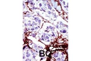 Formalin-fixed and paraffin-embedded human cancer tissue reacted with the primary antibody, which was peroxidase-conjugated to the secondary antibody, followed by AEC staining. (UCK 抗体  (C-Term))