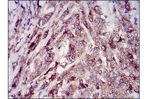 Immunohistochemical analysis of paraffin-embedded prostate cancer tissues using RAB27A mouse mAb with DAB staining.