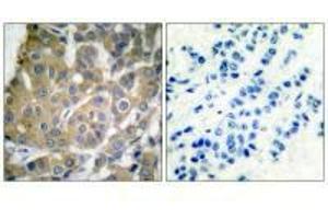 Immunohistochemical analysis of paraffin-embedded human breast carcinoma tissue using Cox2 antibody. (PTGS2 抗体)
