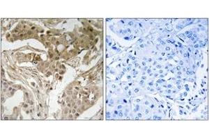 Immunohistochemistry analysis of paraffin-embedded human breast carcinoma, using FOS (Phospho-Thr232) Antibody. (c-FOS 抗体  (pThr232))