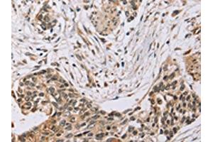 The image on the left is immunohistochemistry of paraffin-embedded Human esophagus cancer tissue using ABIN7130575(PDLIM7 Antibody) at dilution 1/35, on the right is treated with fusion protein. (PDLIM7 抗体)