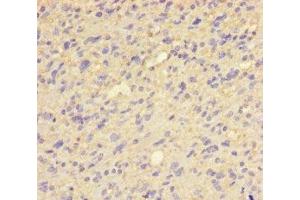 Immunohistochemistry of paraffin-embedded human glioma using ABIN7154027 at dilution of 1:100 (QPCT 抗体  (AA 29-361))