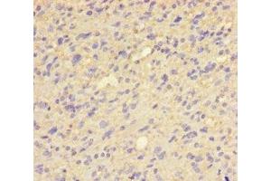Immunohistochemistry of paraffin-embedded human glioma using ABIN7154027 at dilution of 1:100 (QPCT 抗体  (AA 29-361))