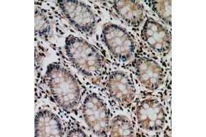 Immunohistochemical analysis of Tyrosyl-tRNA Synthetase staining in human colon cancer formalin fixed paraffin embedded tissue section. (YARS 抗体  (C-Term))