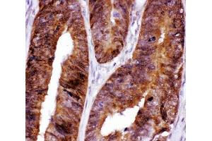 IHC-P: FOXO3A antibody testing of human intestinal cancer tissue (FOXO3 抗体  (AA 471-673))