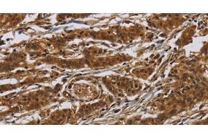 Immunohistochemistry of paraffin-embedded Human gasrtic cancer tissue using GATA5 Polyclonal Antibody at dilution 1:50 (GATA5 抗体)