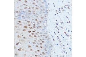 Immunohistochemistry of paraffin-embedded human esophageal cancer using SM antibody (ABIN6128718, ABIN6148113, ABIN6148114 and ABIN6215679) at dilution of 1:100 (40x lens). (SMARCD2 抗体  (AA 454-531))