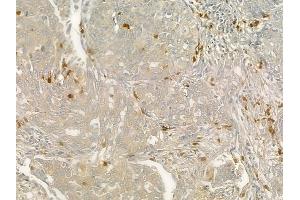 ABIN6260736 and ABIN6276827 at 1/100 staining human lung squamous cell carcinoma by IHC-P. (CEACAM1 抗体  (C-Term))