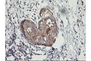 Immunohistochemical staining of paraffin-embedded Adenocarcinoma of Human breast tissue using anti-MTFMT mouse monoclonal antibody. (MTFMT 抗体  (AA 175-389))