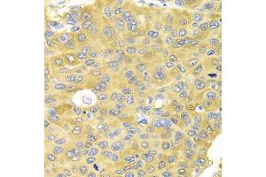 Immunohistochemistry of paraffin-embedded human liver cancer using PA2G4 Antibody (ABIN5973112) at dilution of 1/100 (40x lens). (PA2G4 抗体)