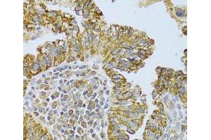 Immunohistochemistry of paraffin-embedded Human endometrial cancer using DLD Polyclonal Antibody at dilution of 1:100 (40x lens). (DLD 抗体)