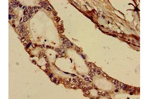 Immunohistochemistry of paraffin-embedded human pancreatic cancer using ABIN7148353 at dilution of 1:100 (C1R 抗体  (AA 65-192))