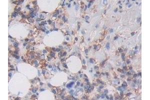 Detection of MHCC in Human Skin cancer Tissue using Polyclonal Antibody to Major Histocompatibility Complex Class I C (MHCC) (MHCC (AA 48-305) 抗体)