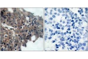 Immunohistochemistry analysis of paraffin-embedded human breast carcinoma, using p21 Cip1 (Phospho-Thr145) Antibody. (p21 抗体  (pThr145))