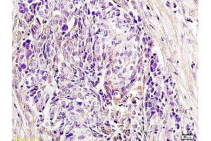 Formalin-fixed and paraffin embedded human laryngocarcinoma labeled with Anti CD336 NKp44 NCR2 Polyclonal Antibody, unconjugated (ABIN740010) at 1:400 followed by incubation with conjugated secondary antibody and DAB staining. (NKp44/NCR2 抗体  (AA 201-276))
