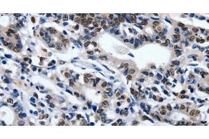 Immunohistochemistry of paraffin-embedded Human gasrtic cancer tissue using CD203c Polyclonal Antibody at dilution 1:80 (ENPP3 抗体)
