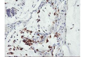 Immunohistochemical staining of paraffin-embedded Adenocarcinoma of Human colon tissue using anti-SDS mouse monoclonal antibody. (serine Dehydratase 抗体)
