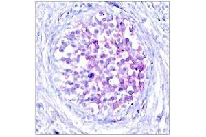 Immunohistochemical analysis of paraffin-embedded human breast carcinoma tissue using Raf1(Phospho-Ser259) Antibody. (RAF1 抗体  (pSer259))