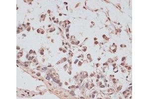 Immunohistochemistry of paraffin-embedded Human gastric cancer using PRPF31 Polyclonal Antibody at dilution of 1:100 (40x lens). (PRPF31 抗体)
