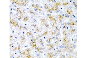 Immunohistochemistry of paraffin-embedded Human liver damage using WNT2 Polyclonal Antibody at dilution of 1:200 (40x lens). (WNT2 抗体)